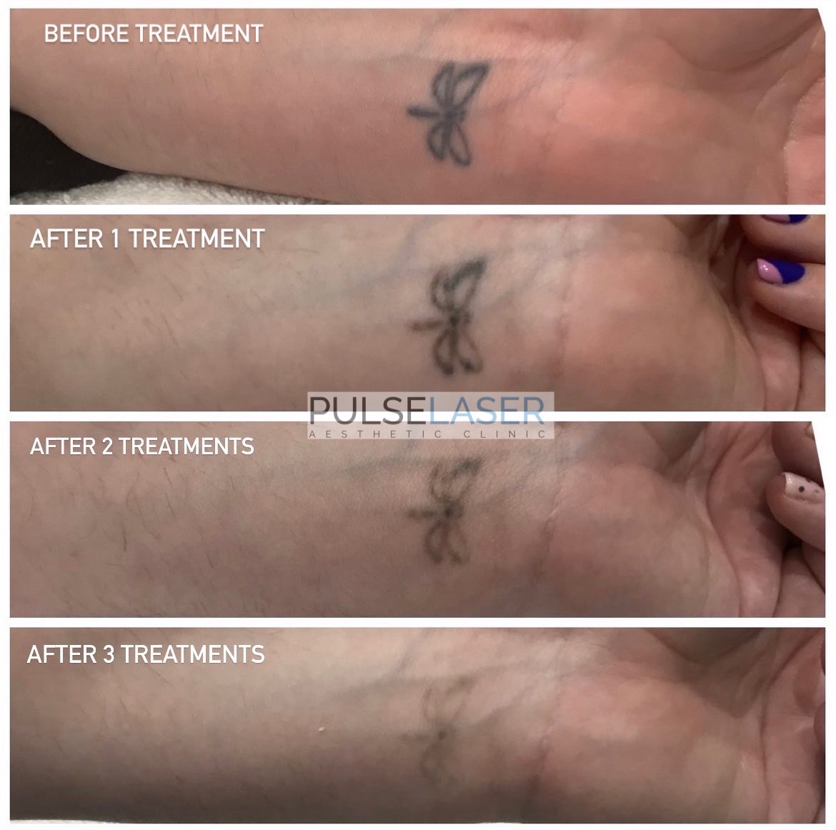 Breaking up With Your Tattoo: Why Laser Tattoo Removal Treatments Are on  the Rise - Laser NY