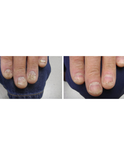 nail